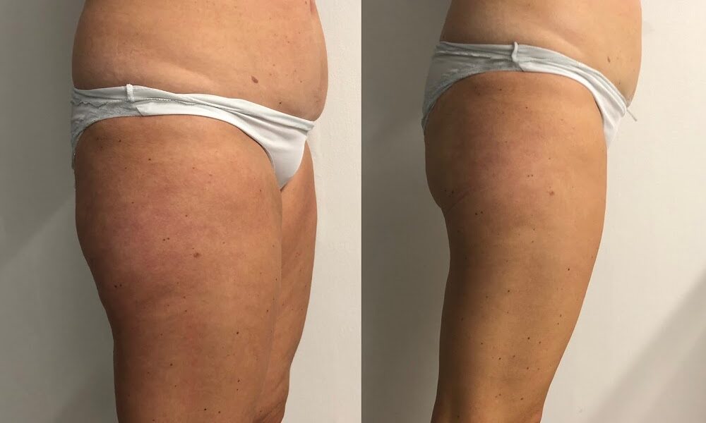 Francine Joyce – Cellulite Treatment