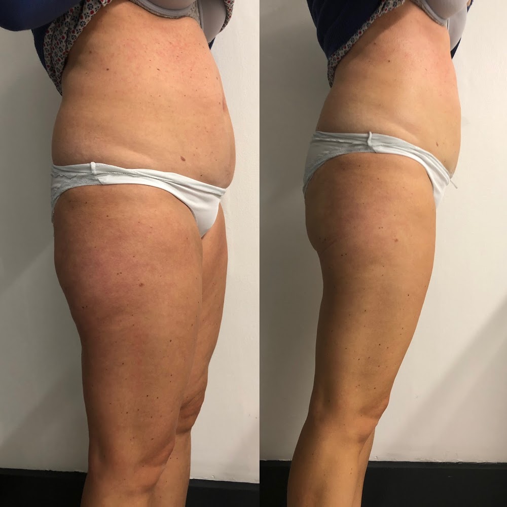 Francine Joyce – Cellulite Treatment